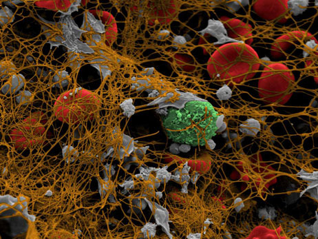 bloodclot_462 Courtesy Andre E.X. Brown, Rustem I. Litvinov, Dennis E. Discher, Prashant K. Purohit, John W. Weisel, University of Pennsylvania / Science via NPR Health Blog