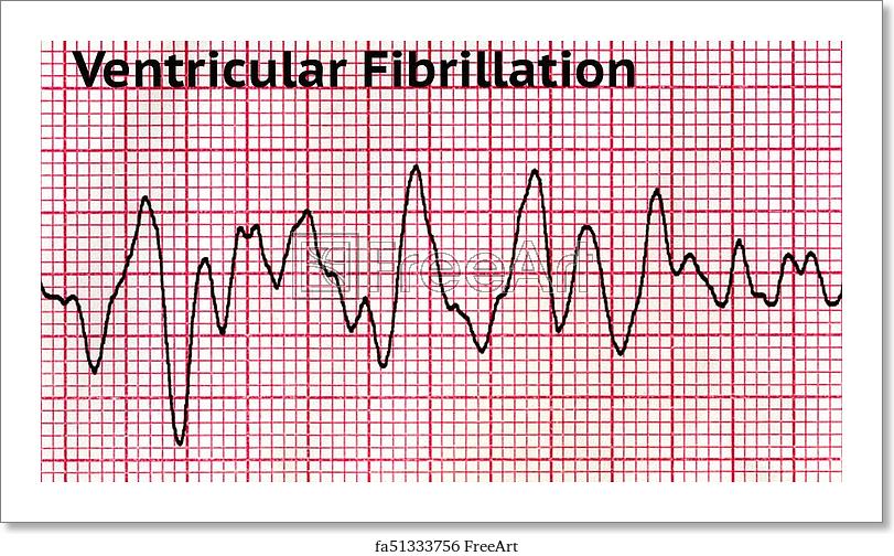 ventricular-fibrillation-deadly-heart-rhythm