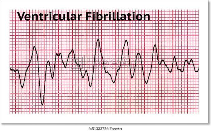 ventricular-fibrillation-deadly-heart-rhythm